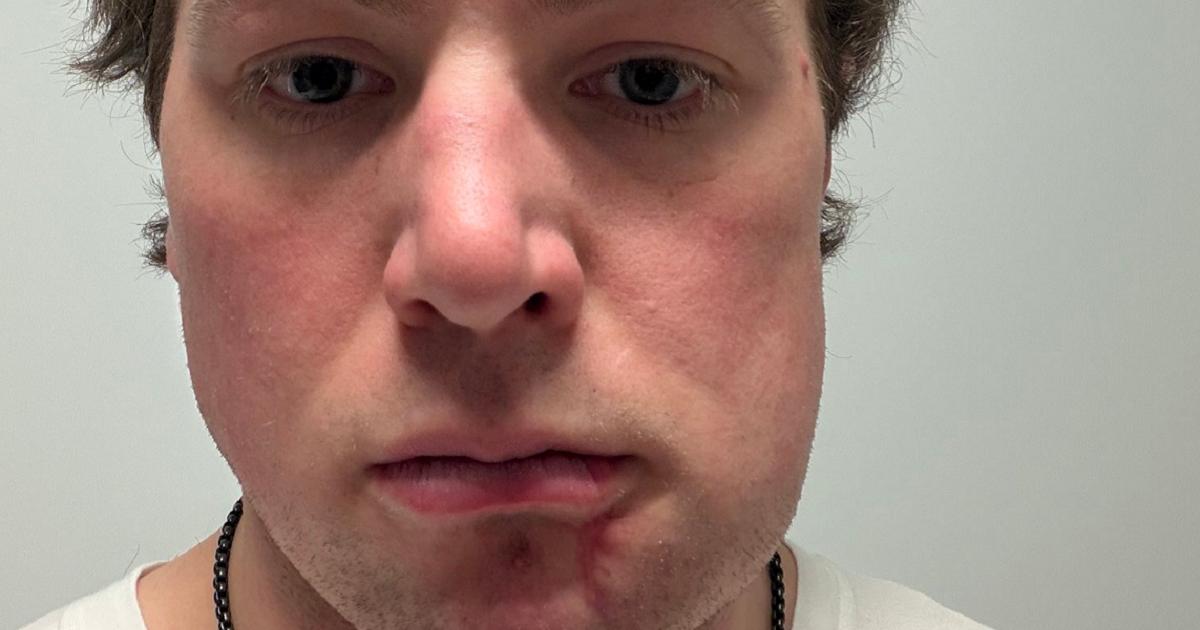 Charlie McAvoy-New-Injury