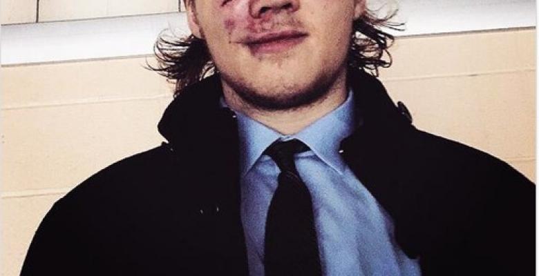 (PHOTOS): Prospect posts picture of his battered face after a rough game.